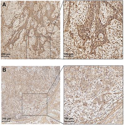 Impact of Astroprincin (FAM171A1) Expression in Oral Tongue Cancer